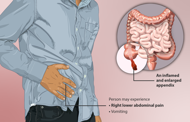 "how to cure appendicitis"