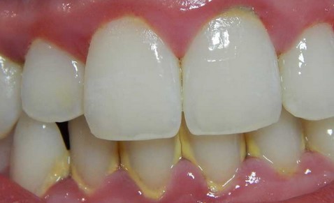 How to Cure Gingivitis (Gum Infection) Naturally with Home Remedies
