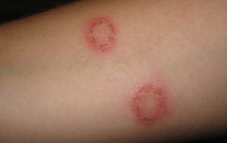How to Get Rid of Ringworm Cream Home Remedies