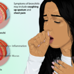 Bronchitis