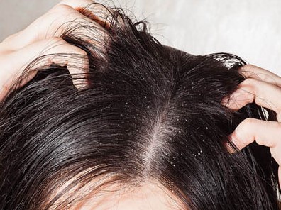 How to remove Get Rid of Dandruff Home Remedies
