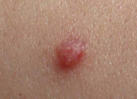 How to Get Rid of Warts Fast Home Remedies