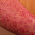 How to Cure Psoriasis Permanently Home Remedies