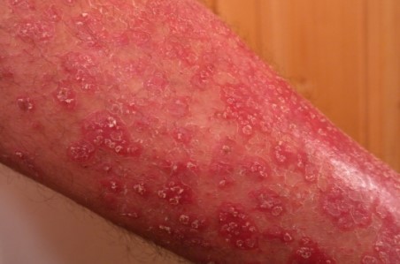 How to Cure Psoriasis Permanently Home Remedies for Psoriasis