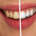 Baking Soda Teeth Whitening