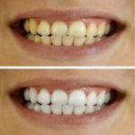 CC BY-NC-ND 4.0 image/jpeg Resolution: 1181×1181, File size: 169Kb, Tooth Whitening photo