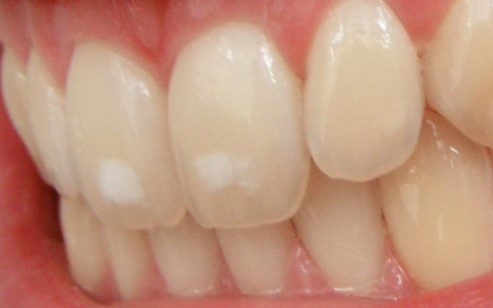 White Spots on Teeth Causes & Remedies to Get Rid of it