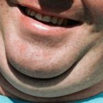 How to Get Rid of Neck Fat Double Chin