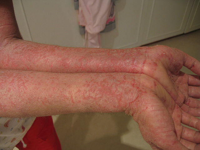 home remedies for eczema
