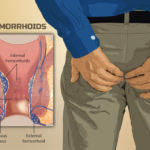 Hemorrhoids