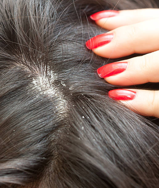 get rid of itchy dry scalp