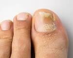 Fungal Nail Treatments