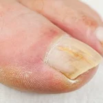 onychomycosis-fungal-nail-infection