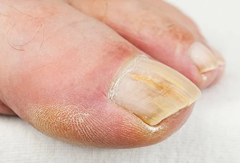 fungal nail treatment